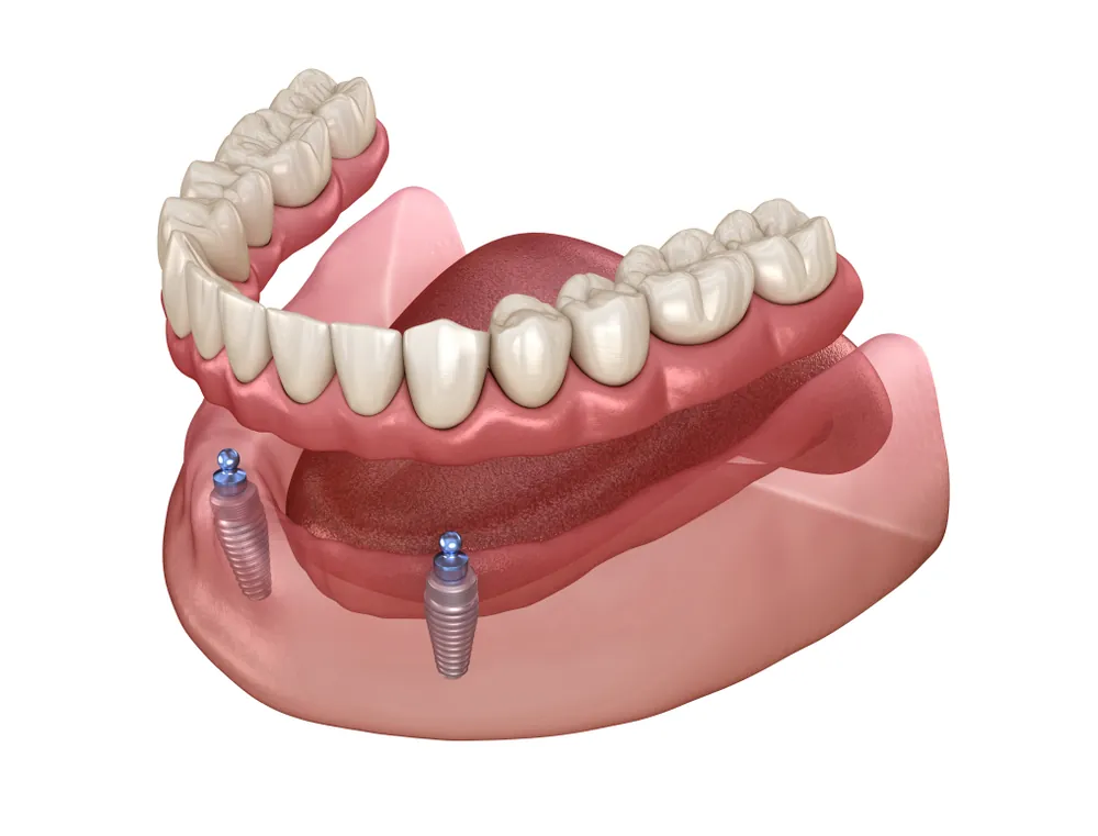 Snap-On Dentures