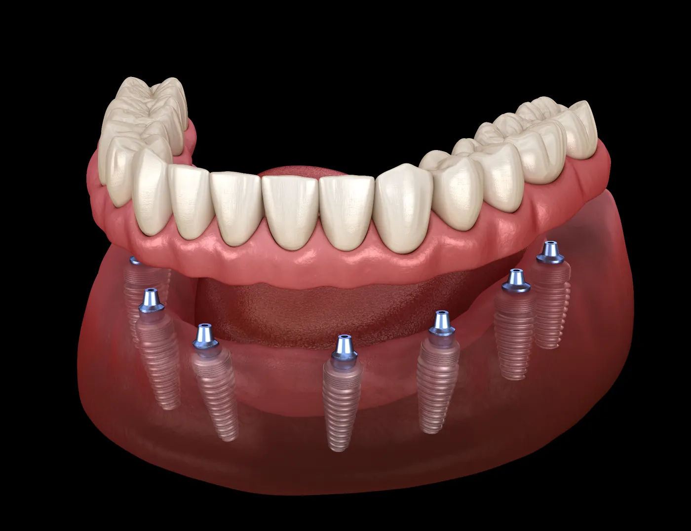 All-on-X Dental Implants